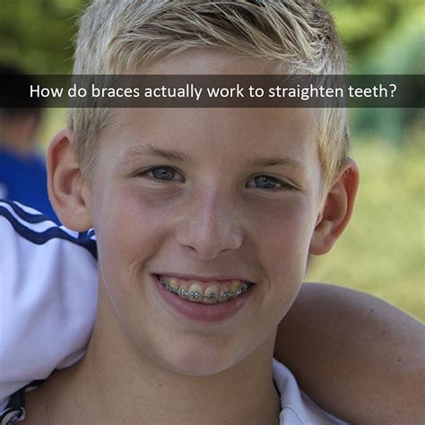 How Do Braces Actually Work Curtis Orthodontics