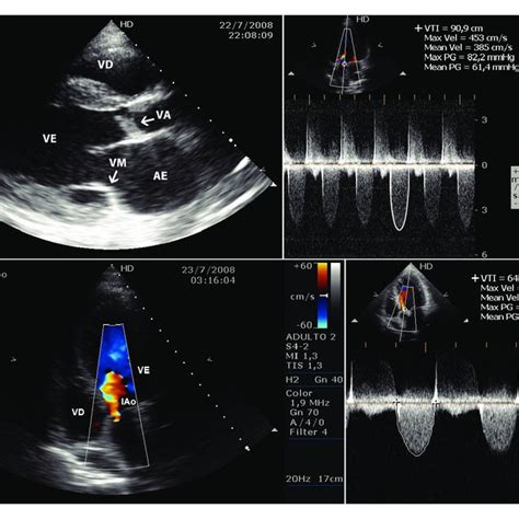 A Doppler Echocardiogram Before And 1b After Percutaneous Aortic