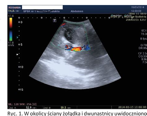 Figure 1 From Intramural Duodenal Hematoma And Acute Pancreatitis As A