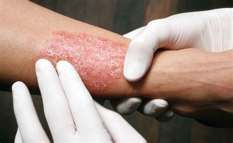 Bryhali Lotion Gets Tentative Approval For Plaque Psoriasis