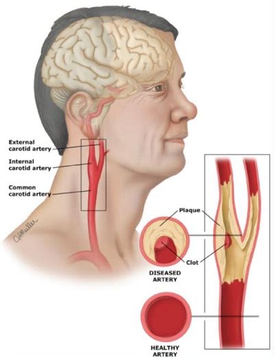 The principal arteries of supply to the head and neck are the two common carotids; Carotid Artery Disease: Symptoms, Diagnosis and Treatment ...