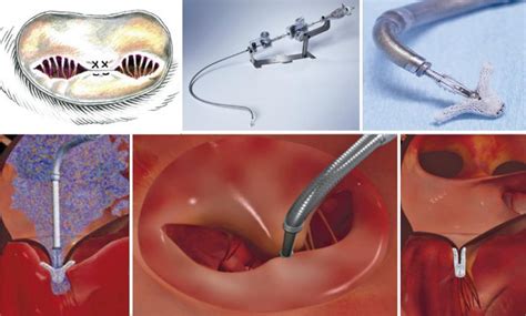 Transcatheter Mitral Valve Repair With Clip For Treatment Of Secondary