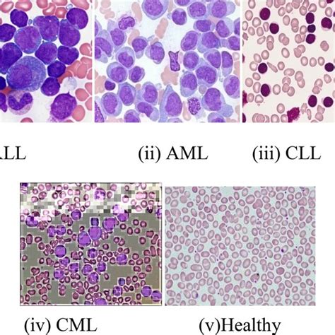 Different Types Of Leukemia I Acute Lymphocytic Leukemia Ii Acute