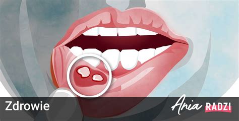 Domowe Sposoby Na Afty W Jamie Ustnej Skuteczne Metody Leczenia