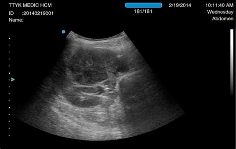 Vietnamese Medic Ultrasound Case 242 Ivc Tumor Dr Phan Thanh HẢi Dr