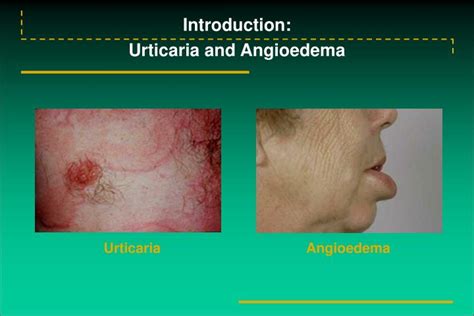 Ppt Introduction Urticaria And Angioedema Powerpoint Presentation