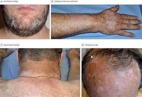 Association Of Vitiligo With Tumor Response In Patients With Metastatic