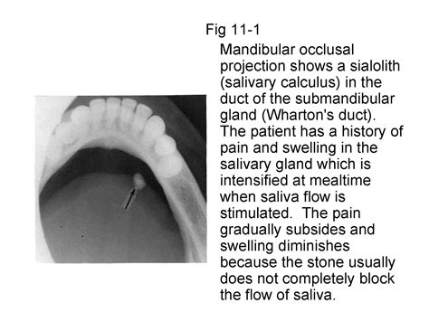 Soft Tissue Calcifications In Oro Maxillo Facial Region With