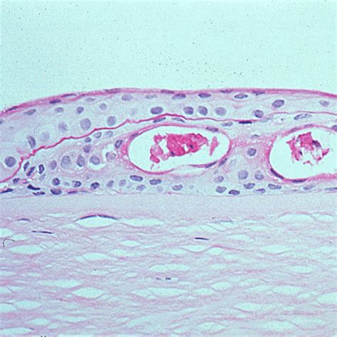 These defects are spots of missing epithelial cells that fall off easily because of the edell e, woodward ma, bunya v. Fuchs corneal dystrophy. Higher magnification of the ep ...