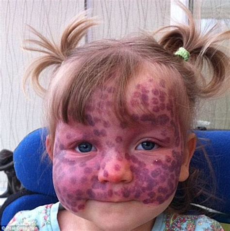 We did not find results for: Six-year-old has rare birth mark which covers her face and ...