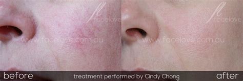 Capillary Redness Reduction Treatment With Led Therapy Facelove