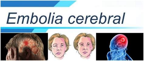 Get what is a thrombosis Embolia Cerebral: ¿Qué Es? Síntomas, Causas, Diagnóstico y ...