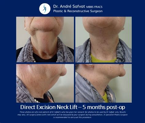 A Different Approach To Neck Lift Direct Excision Neck Lift Asaps