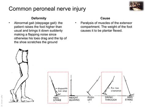 Applied Anatomy Common Peroneal Nerve Injury