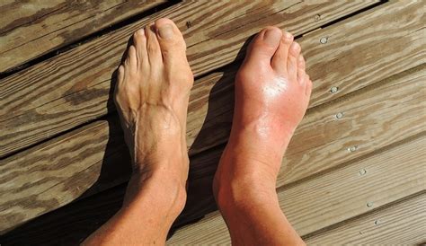 How To Deal With The Swelling Of The Top Of Your Foot Md