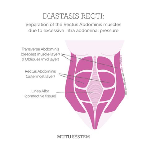 Diastasis Recti Information Ideas Diastasis Diastasis Recti The Best
