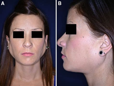 Bilateral Parotid Sialadenosis Associated With Long Standing Bulimia A