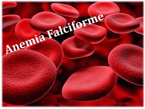 Anemia Falciforme Enfermagem Bio