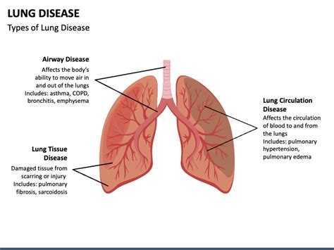 Lung Disease Powerpoint Template Ppt Slides