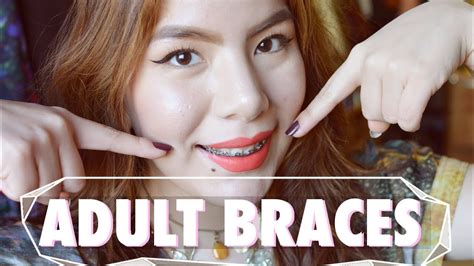 Maybe you would like to learn more about one of these? ADULT BRACES, HUGE Overbite! Experience & Q+A - YouTube