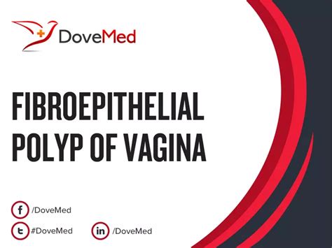 Fibroepithelial Polyp Of Vagina Dovemed