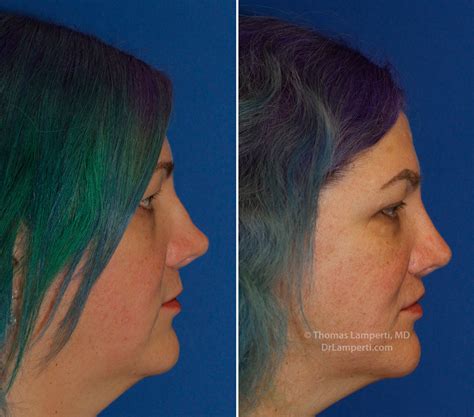 Photos Saddle Nose Deformity Before And After Repair Rhinoplasty In