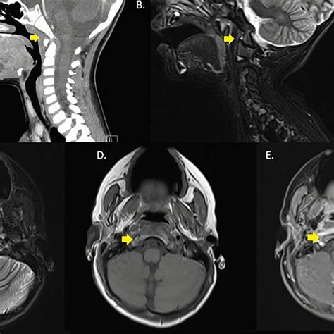 Grisel Syndrome A Sagittal Section Contrast Enhanced Ct Of The Neck