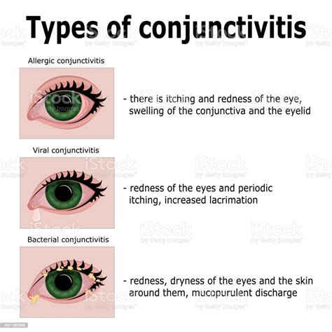 Die virale konjunktivitis ist die häufigste ursache für ein akut gerötetes auge. Types Of Conjunctivitis Stock Illustration - Download ...
