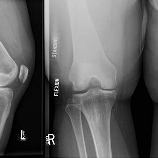 Lateral And Standing Flexion Plain Radiographic Views Of The Left Knee Download Scientific