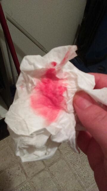 Please Say This Is Implantation Bleeding It Is Bright Pink As You Can