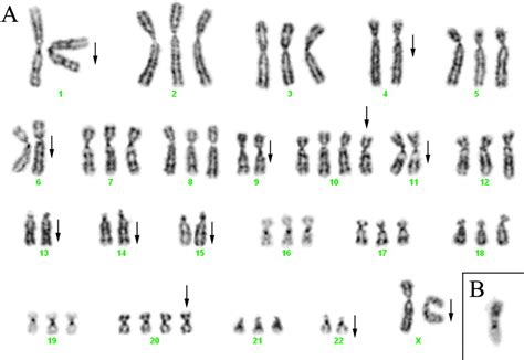 Chromosome Abnormalities In Juxtaglomerular Cell Tumors Brandal