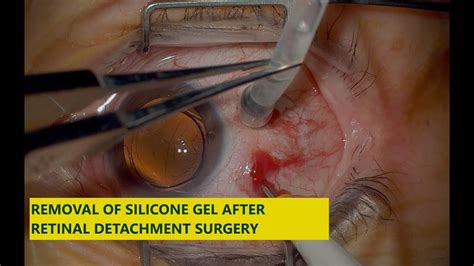 Read about a detached retina, which is where the thin layer at the back of the eye (retina) becomes we'd also like to use analytics cookies. Silicone oil removal , after retinal detachment surgery ...