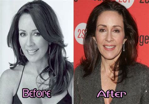 Patricia Heaton Before And After Plastic Surgery Celebrity Before And