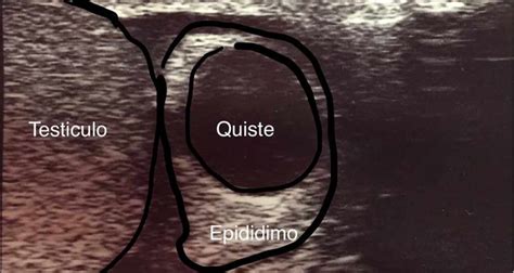 Quiste testicular o espermatocele o quiste de epidídimo