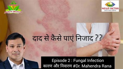 Fungal Infection Episode 2 Fungal Infection In Private Parts फंगल