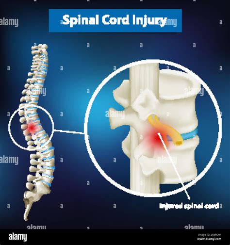 Diagram Showing Spinal Cord Injury Illustration Stock Vector Image