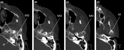 Radiation‐induced Temporo‐mandibular Joint Disorder In Post