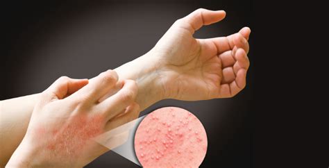 10 Most Common Skin Diseases And Skin Disorders Reviews And Appointment