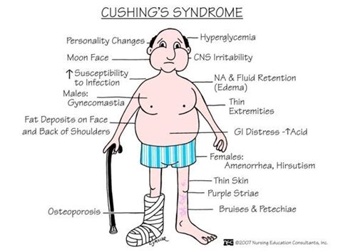 Cushings Syndrome Healthcare Infographics Nursing Diagnosis