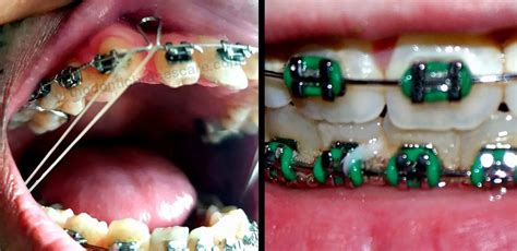 How Long Do You Wear Braces Rubber Bands For Overbite Orthodontic