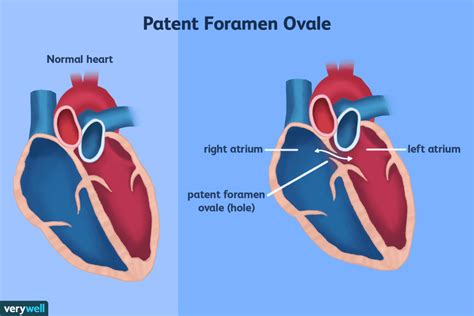Patent Foremen Ovale Pfo And Atrial Septal Defect Asd Percutaneous