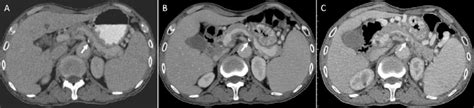 Serial Contrast Enhanced Abdominal Computed Tomography Scans Of The