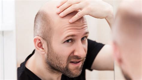 Scientists Discover Potential Cure For Baldness And It Could Be Due