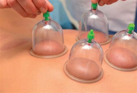 Cupping Therapy Coastherapy