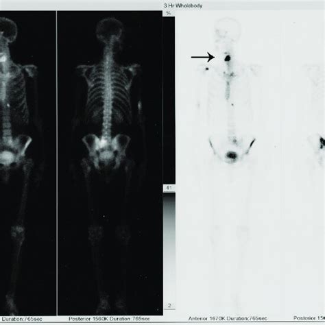 Bone Scintigraphy Shows Accumulation Of Tc 99m At The Two Sites Of The