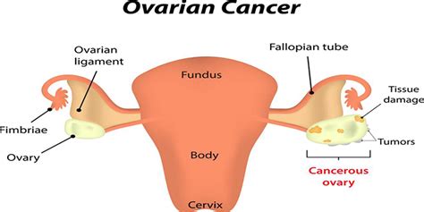 Ovarian Cancer Symptoms 10 Early Warning Signs You Need To Know