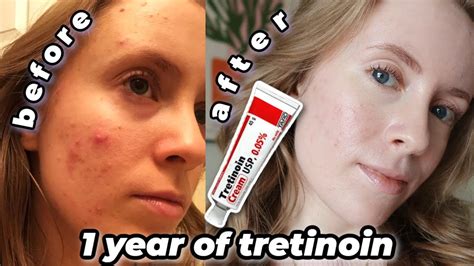 1 Year Tretinoin Update Before And After My Current Skincare Routine Tretinoin Cream 005