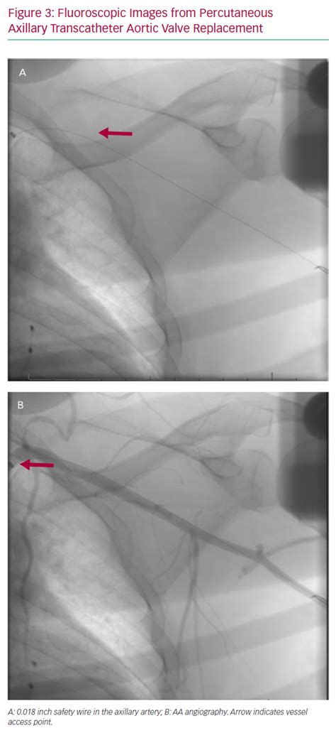 Fluoroscopic Images From Percutaneous Axillary Transcatheter Aortic