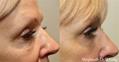 Treatment For Under Eye Bags And Dark Circles Morpheus 8 Los Angeles