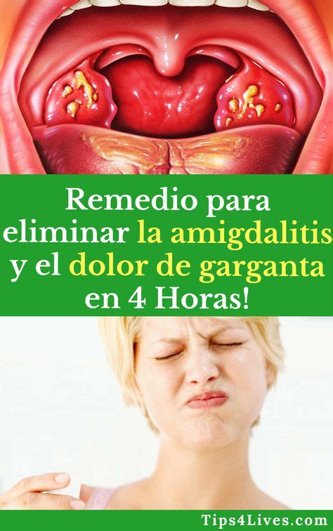 Remedio Para Eliminar La Amigdalitis Y El Dolor De Garganta En 4 Horas